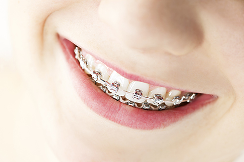 Placerville Dental Braces