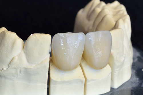 Ceramic Crowns in Placerville