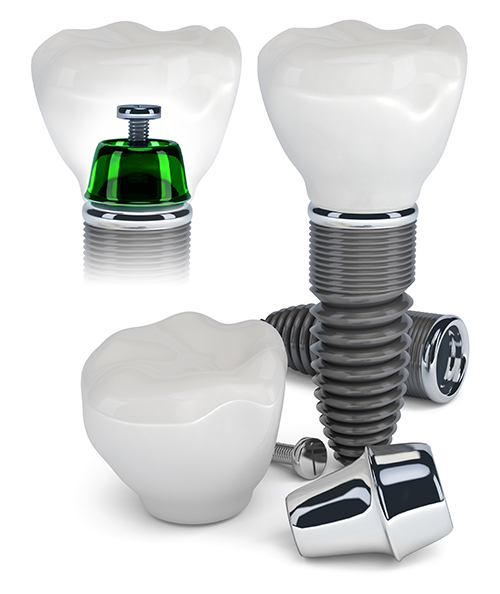 Dental Implants in Placerville