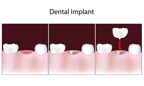 Implant Dentistry in Placerville