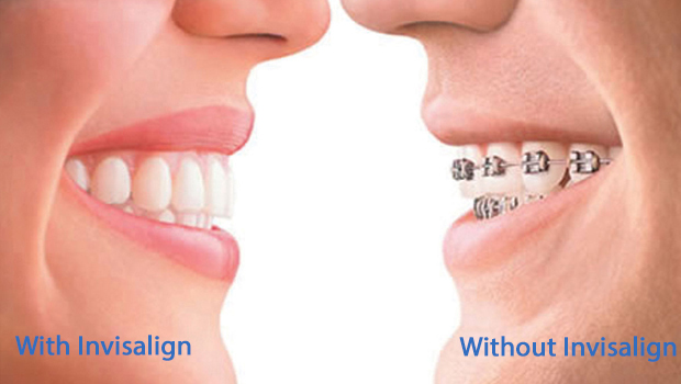 Placerville Invisalign