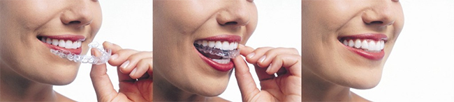 Invisalign near Greenstone