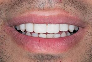 Serrano Before and After Invisalign