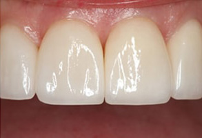 Serrano Before and After Invisalign