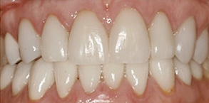 Gold Country Before and After Teeth Whitening