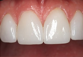 Placerville Before and After Teeth Whitening