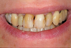 Placerville Before and After Teeth Whitening