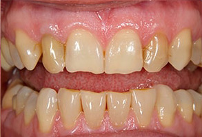 Gold Country Before and After Teeth Whitening