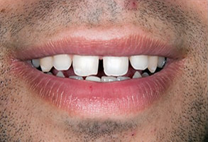Serrano Before and After Invisalign