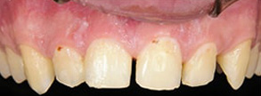 Greenstone Before and After Crown Lengthening