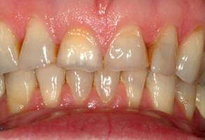 Placerville Before and After Teeth Whitening