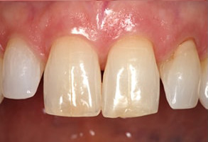 Serrano Before and After Invisalign