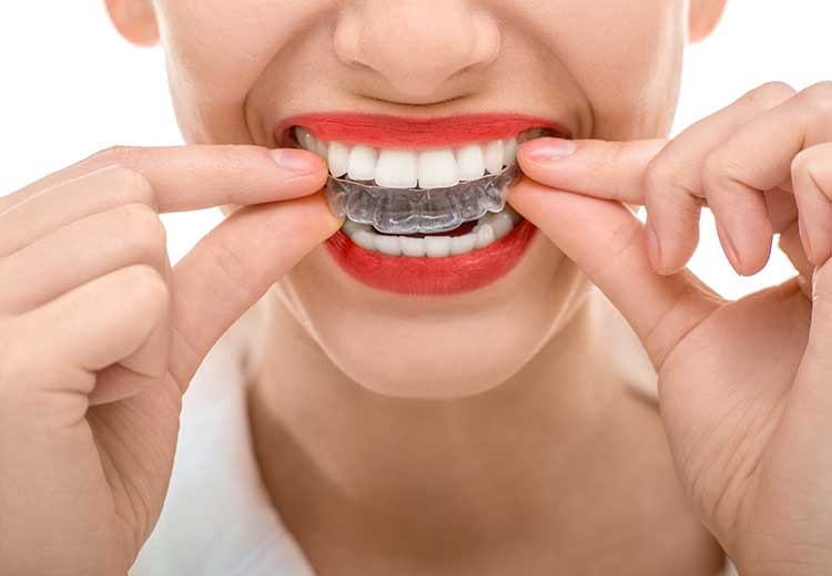 Invisalign in Placerville